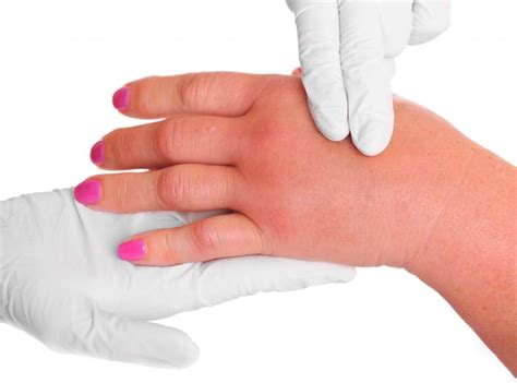 How Do I Choose The Best Treatment For Swollen Hands And Feet
