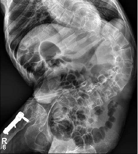 Plain Abdominal Radiographic Finding It Shows A Severe Spinal
