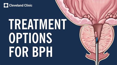 Benign Prostatic Hyperplasia BPH KlinikHaus
