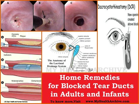 Home Remedies For Blocked Tear Ducts In Adults And Infants Health