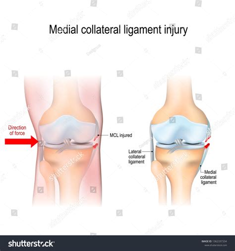 Medial Knee Injuries Joint Anatomy Illustration
