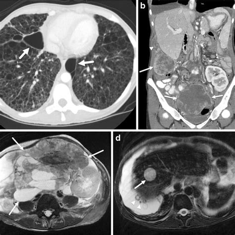 Tuberous Sclerosis Complex And Lymphangioleiomyomatosis Lam In An