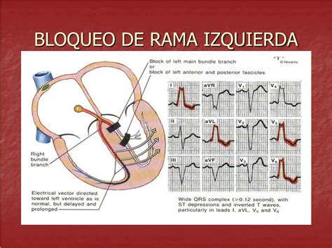 Ppt Electrocardiografia Alteracion De La Conduccion Ventricular