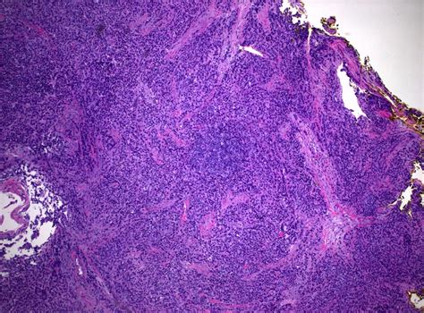 Pathology Outlines Large Cell Neuroendocrine Carcinoma