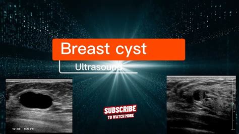 Breast Cyst Ultrasound Echography Breast Cyst Echogaphie Kyste