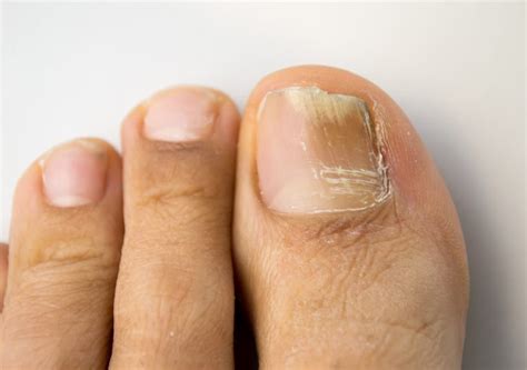 Fungal Nails Parkdale Foot Clinic Common Foot Problems
