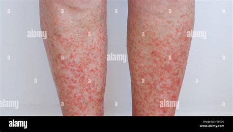 White Bumps On Lower Legs