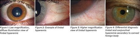 How To Manage Patients With Limbal Redness Limbal Hyperaemia