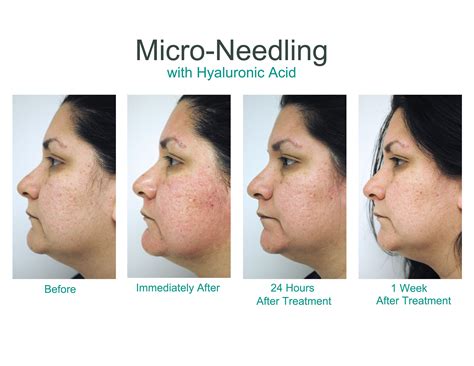 Rf Microneedling Acne Scars Before And After Acne Treatment