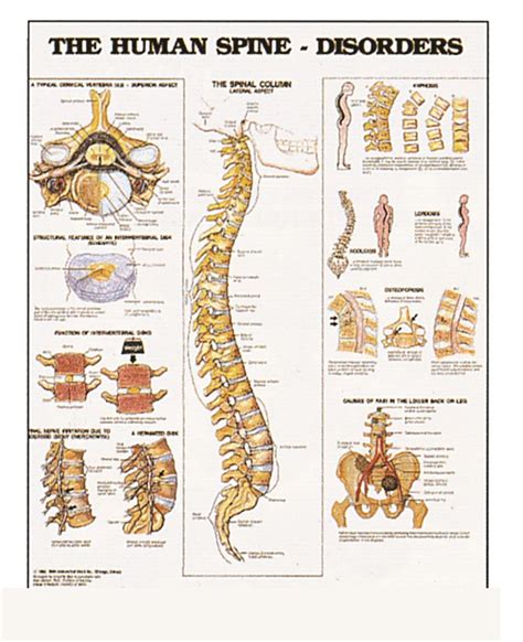 Wall Chart The Human Spine Disorders Single Hillcroft Supplies