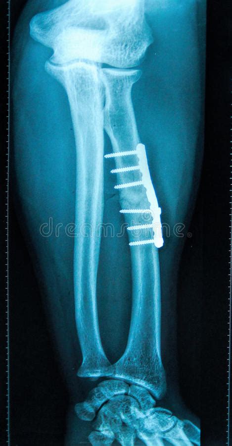 X Ray Of Fractured Leg Bone Stock Image Image Of Anatomy Implant