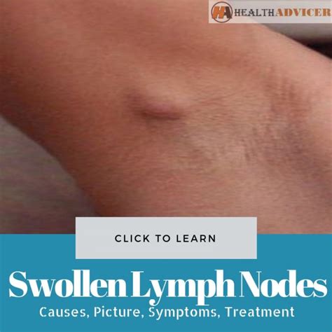 Swollen Lymph Nodes Under The Arm Causes Symptoms Treatment
