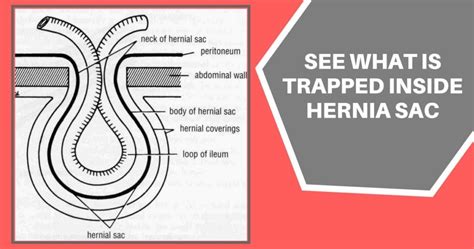 A Brief On The Unusual Contents Of Inguinal Hernia Dr Maran