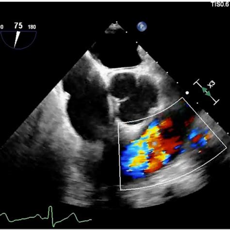 Midesophageal Right Ventricular Inflow Outflow Tee View Obtained During