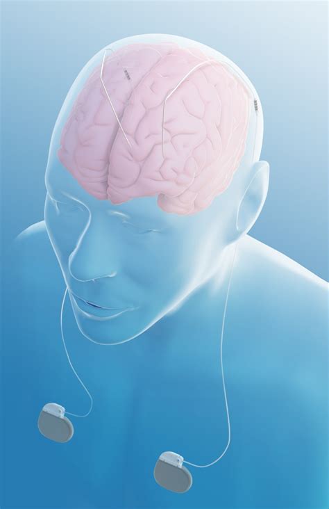 La Stimolazione Cerebrale Profonda Per La Cura Dellepilessia Approvato Dalla FDA Un Nuovo