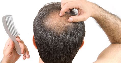 The Best Ways To Deal With A Balding Crown