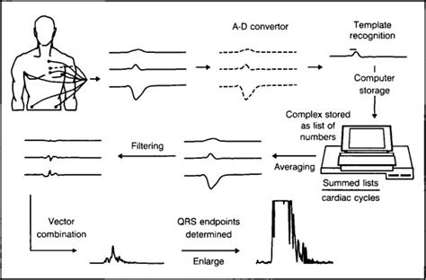 Signal Averaged Electrocardiography A New Noninvasive Test To Identify