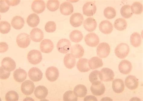 Kostenlose Bild Plasmodium Vivax Ring Erythrozyten Parasiten