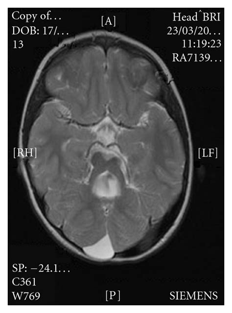 Cranial T2 Magnetic Resonance Image For Bz—this Shows An Enlarged 4th