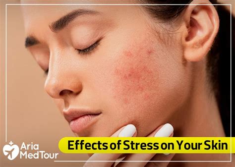 How Stress Can Affect Your Skin Ariamedtour