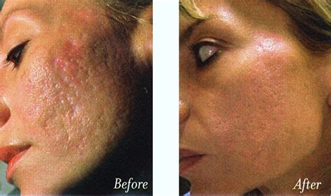 Best Treatment For Acne Scars And Large Pores Acne Scars Treatment
