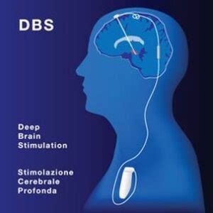 Parkinson le novità sulla DBS stimolazione cerebrale profonda