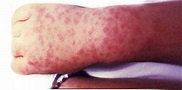Rocky Mountain Spotted Fever (RMSF) | CDC
