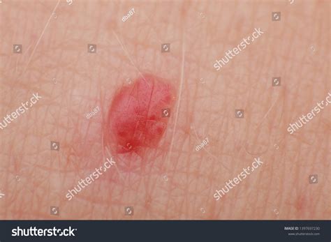 Cherry Angiomas On Male Skin Super Stock Photo 1397697230 Shutterstock