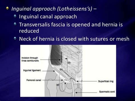 Femoral Hernia Repair