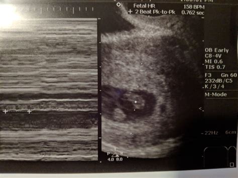 Post Your Ultrasounds Here Page 3 — The Bump