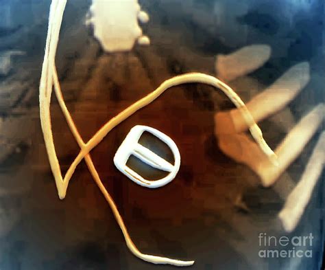 Prosthetic Aortic Valve And Pacemaker Wires Photograph By Zephyr