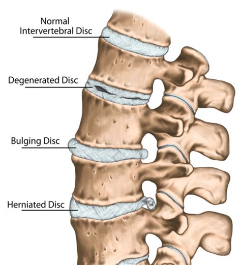 what does a broad based disc bulge mean dane101