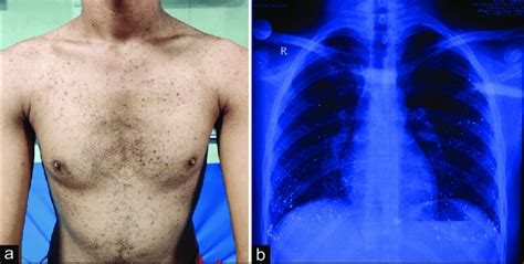 A Hyperpigmented Papules Present Over The Trunk B Chest X Ray