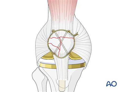 Cerclage Wire For Fracture Around Stable Patellar Component And Good