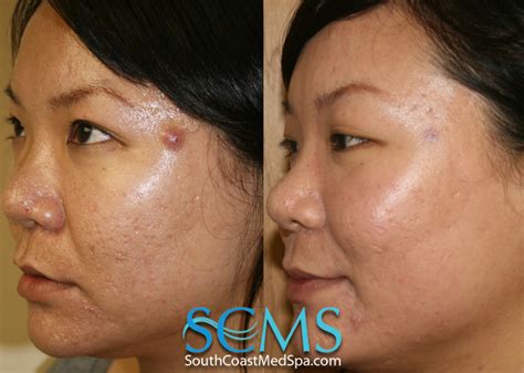 Light And Dark Skin Laser Acne Scar Removal Asian Skin