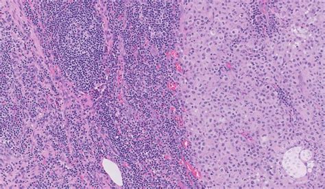 Lymph Node With Metastatic Melanoma