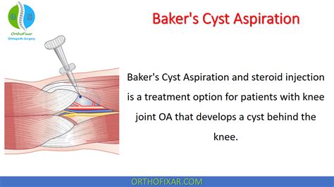 Bakers Cyst Aspiration Orthofixar 2024