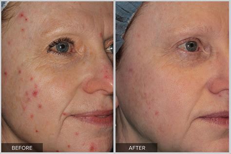 Bbl Acne Laser Treatment At Pynch Anti Aging And Med Spa Services