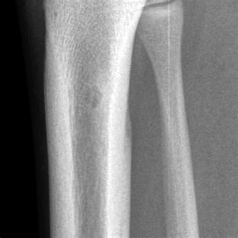 Osteoid Osteoma Image
