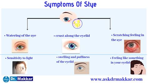 Styechalazion Causes Symptoms Stye Vs Chalazionnon Surgical