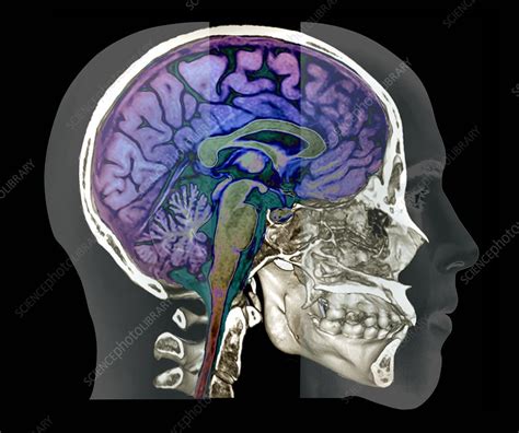 Human Skull And Brain Ct And Mri Scans Stock Image C0480695
