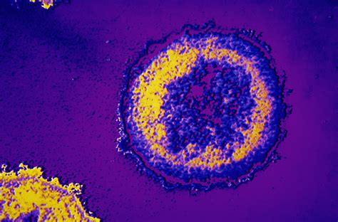 Closer To An Hiv Cure No Trace Of Virus After 2 Men Underwent Stem