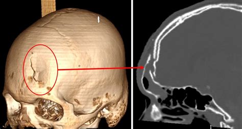 Frontal Bone Fracture And Frontal Sinus Injury Radiology Cases