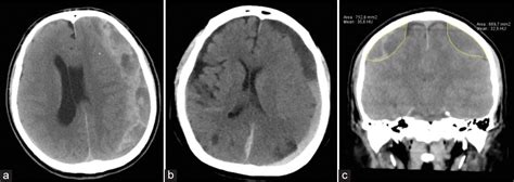 Hematoma Subdural Crónico Una Patología Común De Manejo Complejo