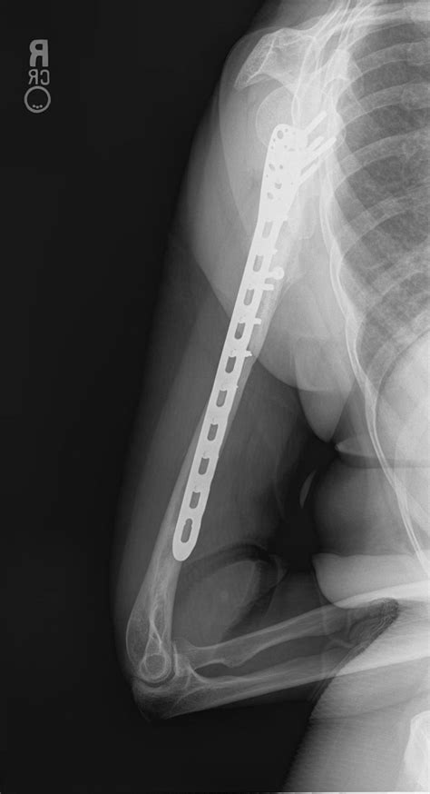 Nonunion: Humerus Case 3 - Dr. Mark Brinker, Houston ...