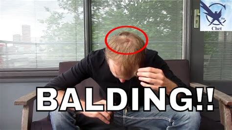 How To Deal With Balding Youtube