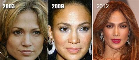 Jennifer Lopez Before And After Plastic Surgery 07 Celebrity Plastic