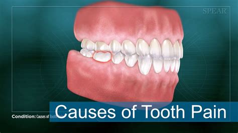 Cause Of Tooth Pain Dentist In Cary