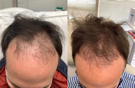 Keralase Hair Restoration Before And After Photos Patient 40 Washington Dc Mi Skin