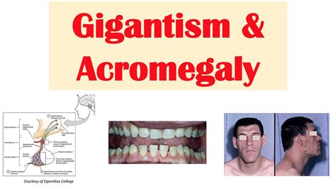 Gigantism And Acromegaly Growth Hormone Signs And Symptoms Diagnosis